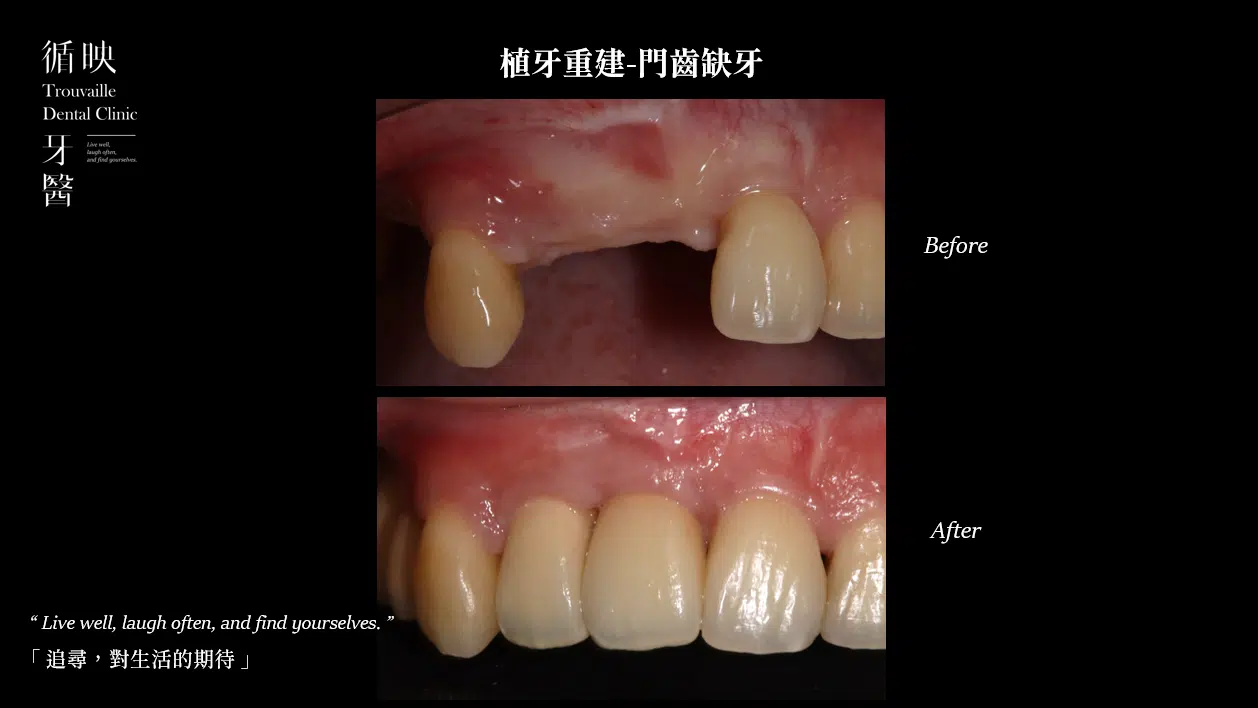 植牙案例分享：門齒缺牙處理