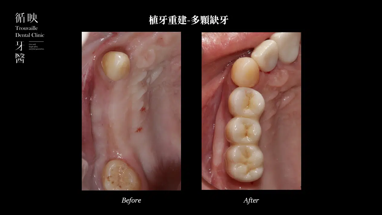 植牙案例分享：多顆缺牙重建