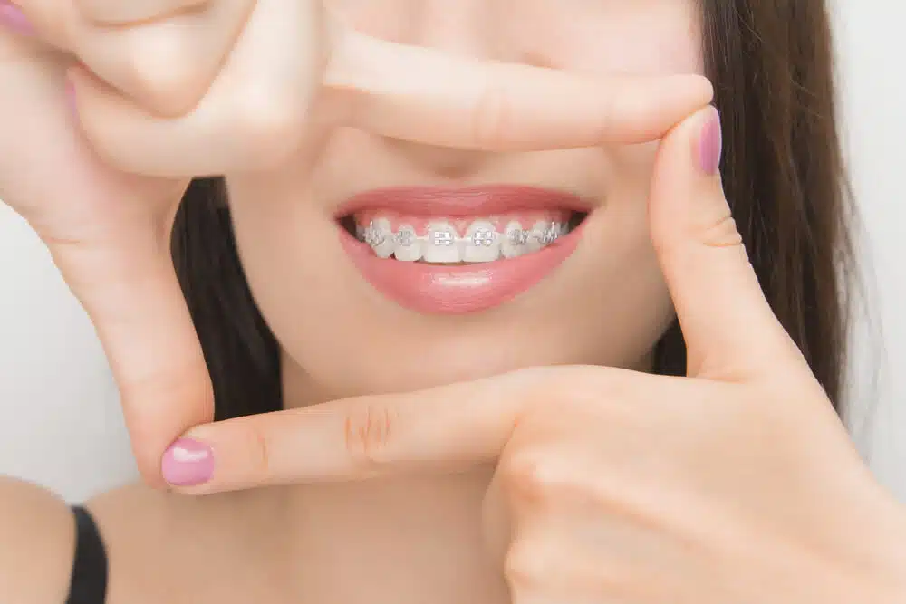 矯正牙齒過程是什麼？