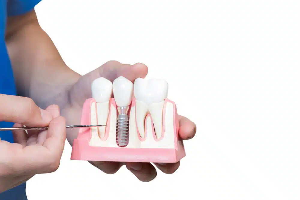 植牙補骨是植牙的重要步驟