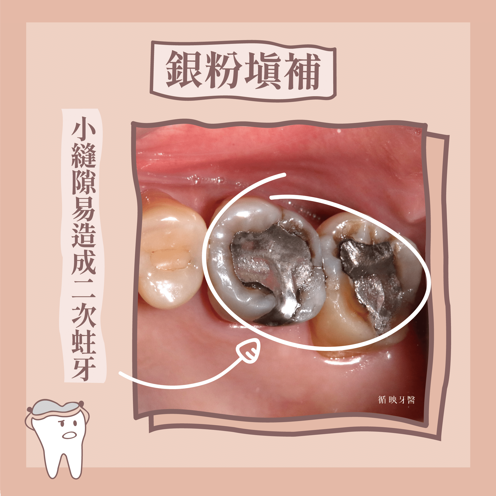 銀粉填補時間久了，常見牙齒被染色及二次蛀牙的狀況。