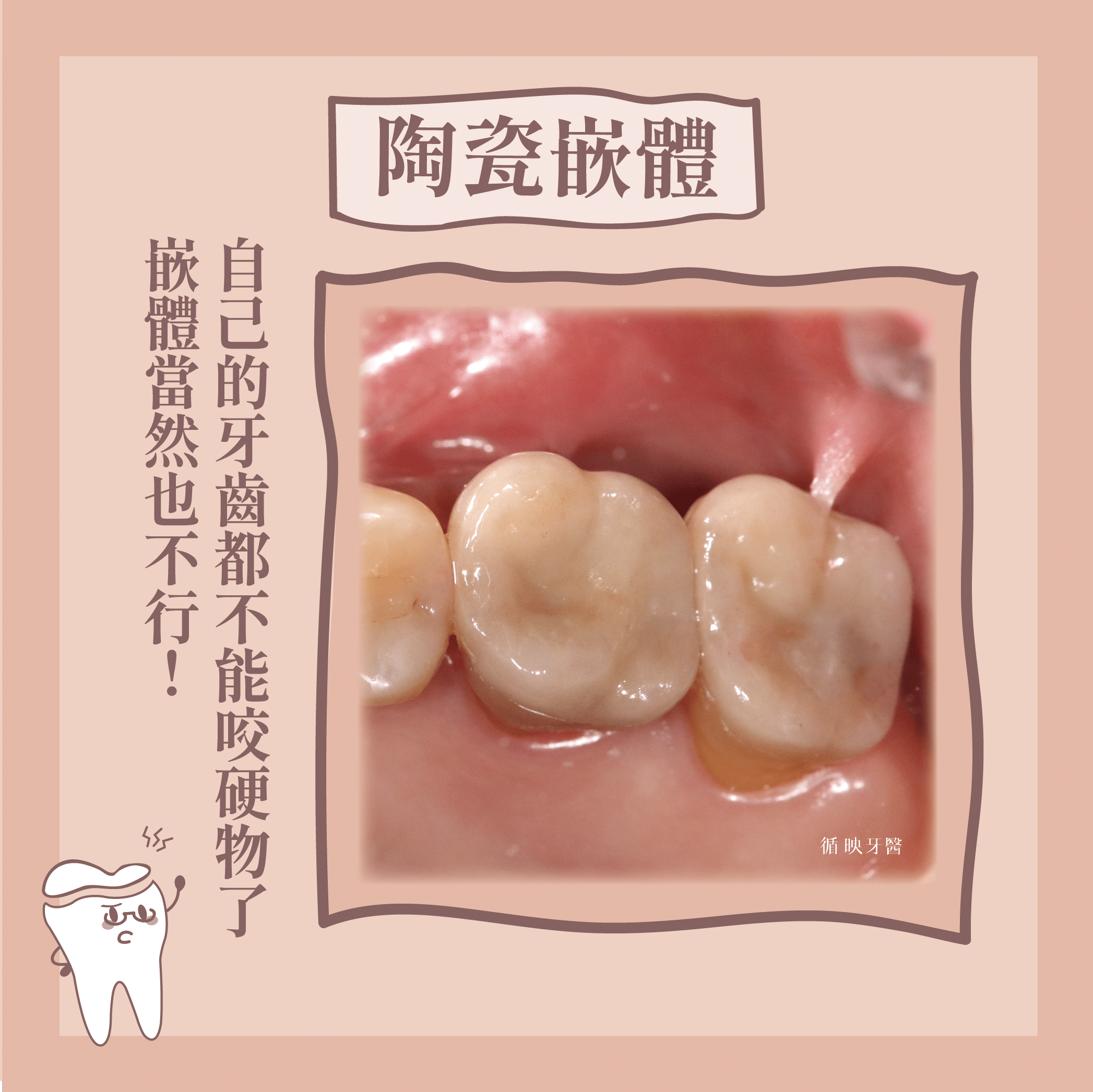 陶瓷嵌體強度好，但自己的牙齒都不能承受硬物了，陶瓷嵌體當然也不行！