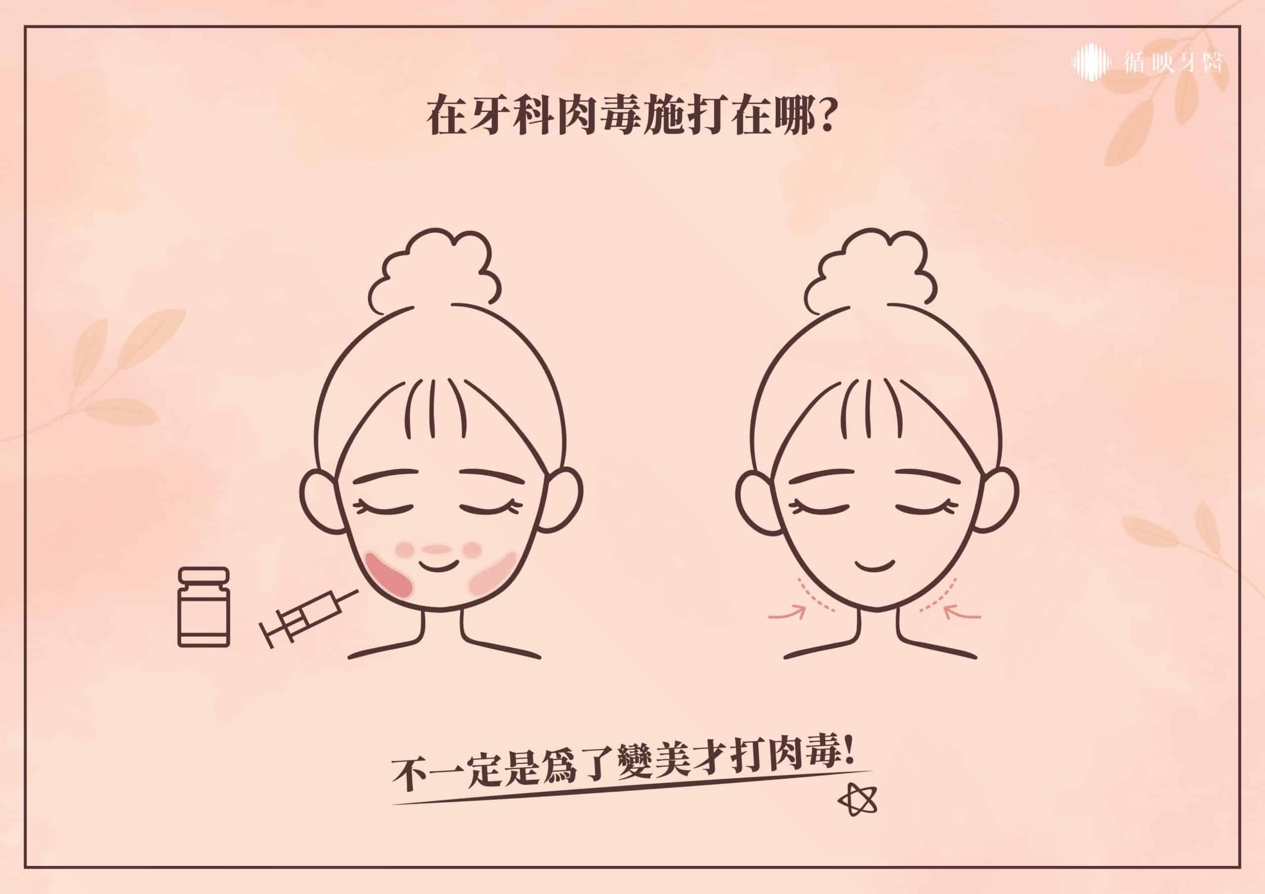 以牙科為例，為了改善咬合力量過大、磨牙、與肌肉過度發達的狀況時，醫師將在咀嚼肌的位置進行注射。