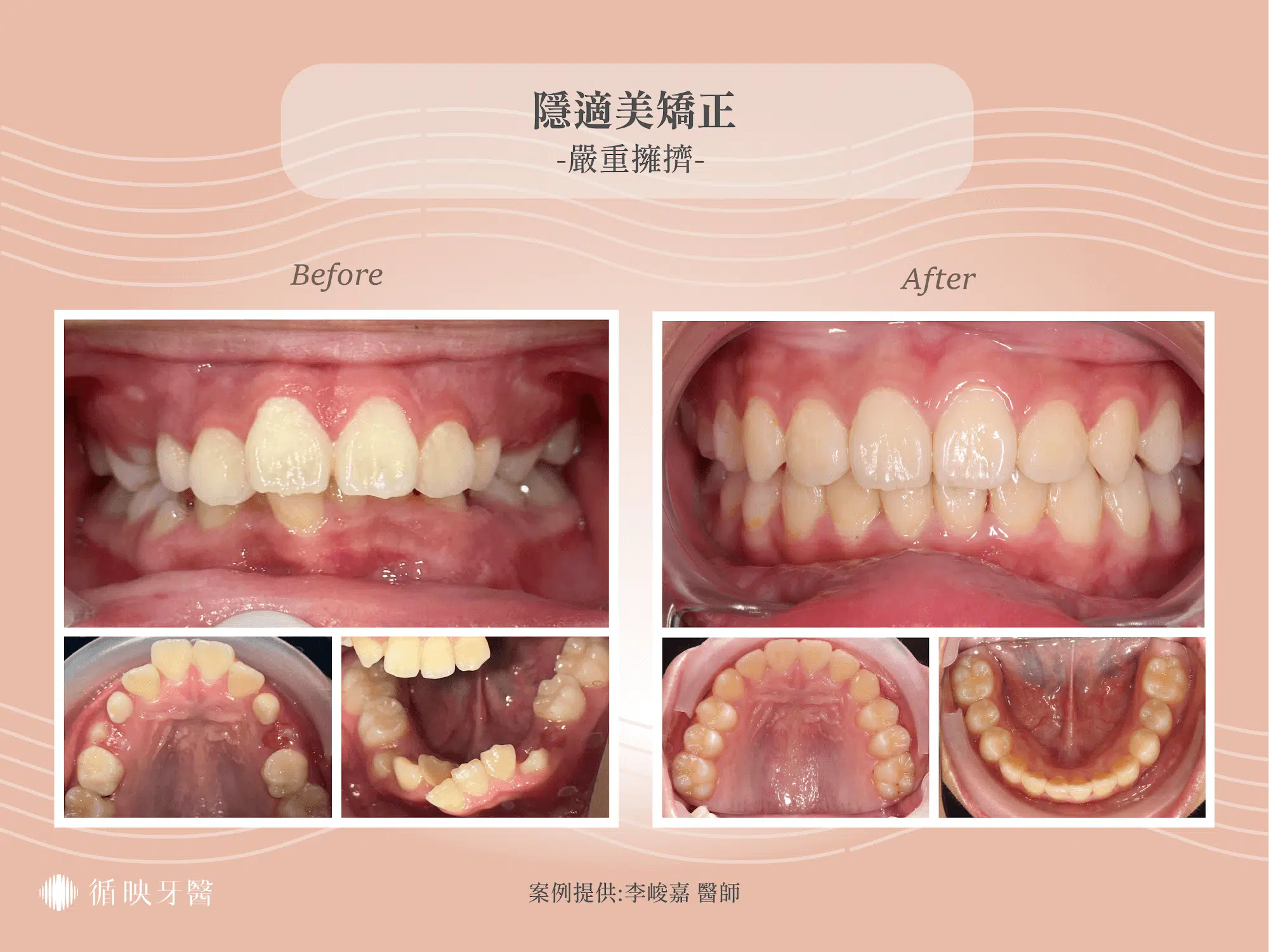 兒童隱適美嚴重擁擠案例