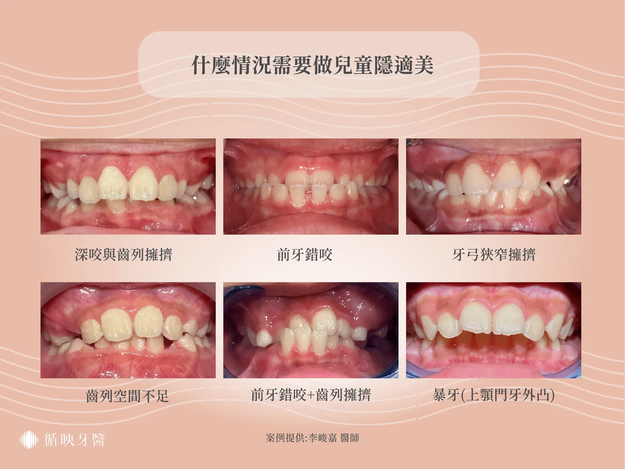 需要做隱適美的兒童狀況統整