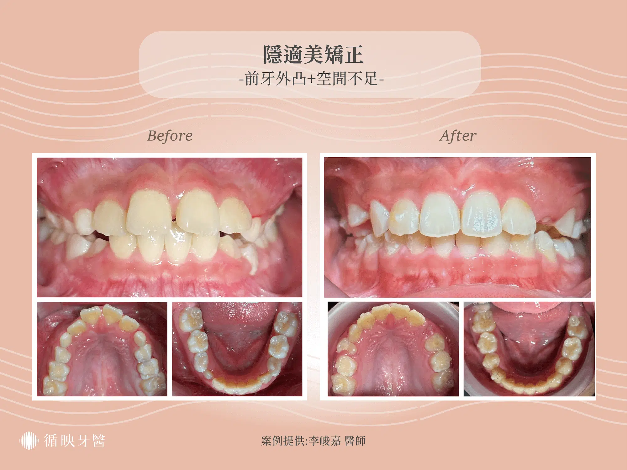 兒童隱適美前牙外凸空間不足案例