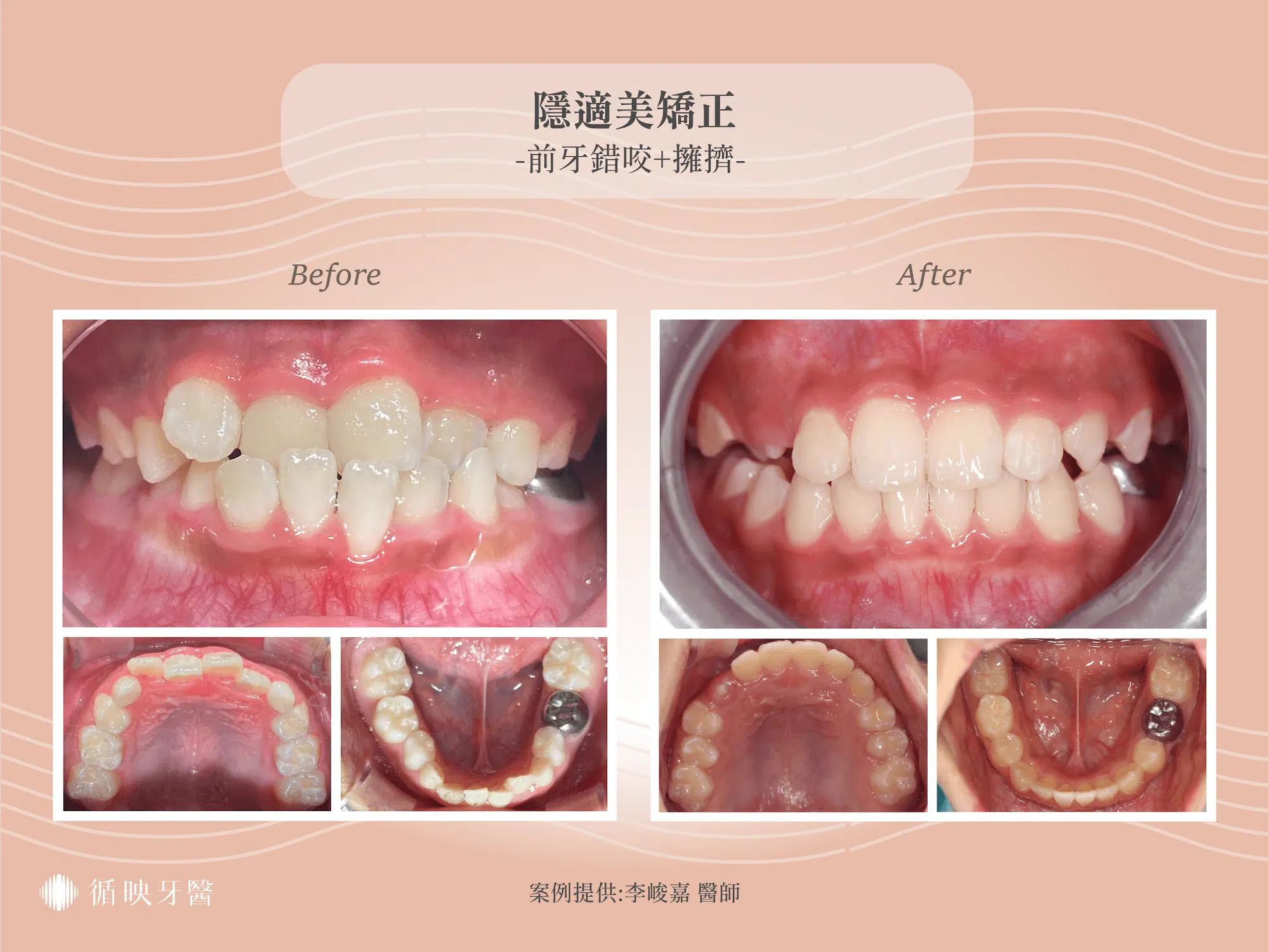 兒童隱適美前牙錯咬擁擠案例